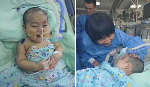 PICU里7个月大的微笑宝宝：戴86天呼吸机 经历数十次抢救